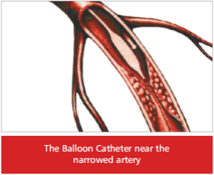balloon-catheter-angioplasty-hyderabad-300x246