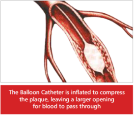 balloon-catheter-angioplasty-plaque-300x258