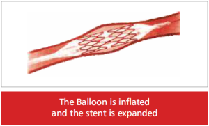 balloon-stent-expanded-300x181