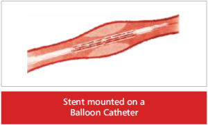 heart-stent-mounted-300x180