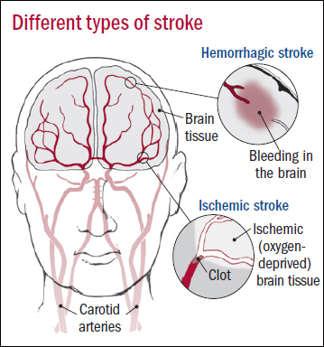 types-of-stroke1
