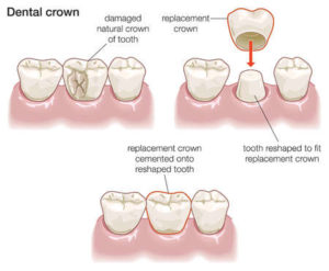 crowns-best-dental-hospitals-in-visakhapatnam-300x247